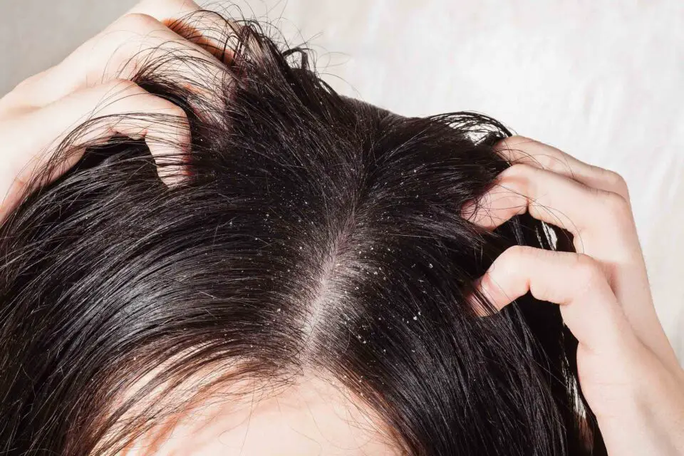 the side effects of Rogaine include scalp irritation and dry flakes