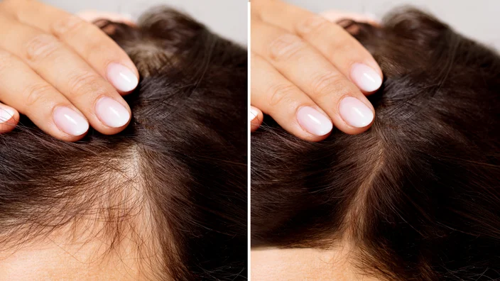 Best Thinning Hair Treatment